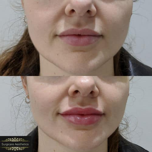 before & after lip enhancement