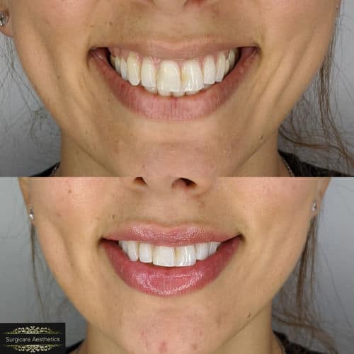 before & after lip augmentation