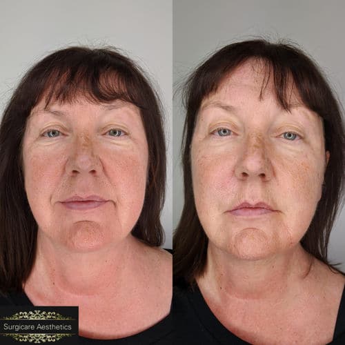Nasolabial Line Treatment Before and After