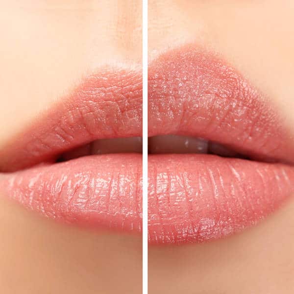 Lip fillers