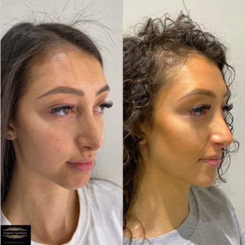 cheek filler treatment