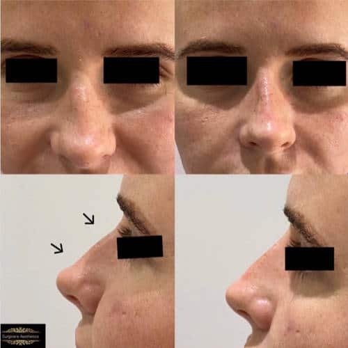 non-surgical rhinoplasty treatment