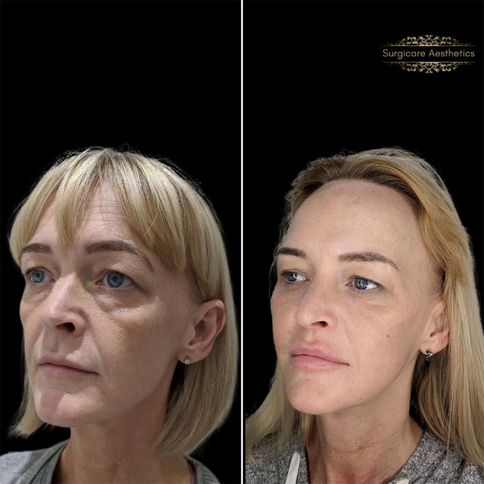 Structural Rejuvenation (3_3)