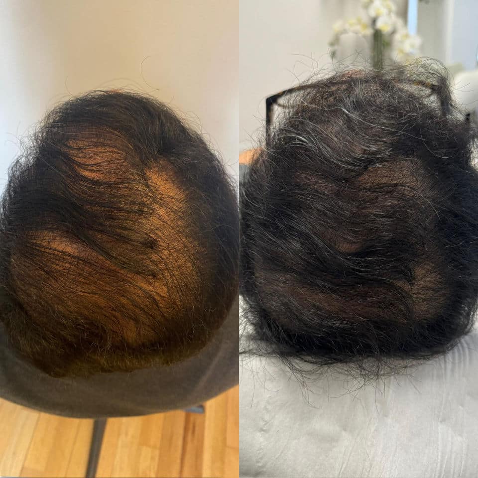 PRP Haire Rejuvenation