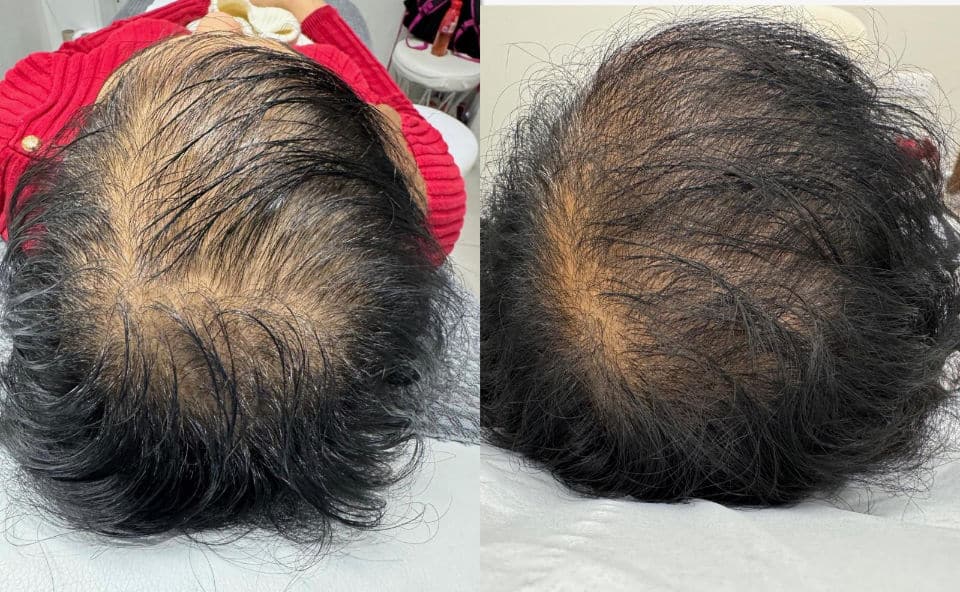 prp before and after(2)