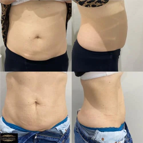 AQUALYX Fat Dissolving Injections