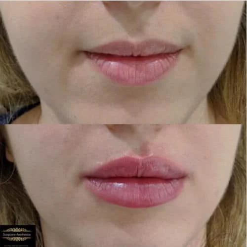 Before and After 1ml Lip Filler with Juvederm Ultra 3