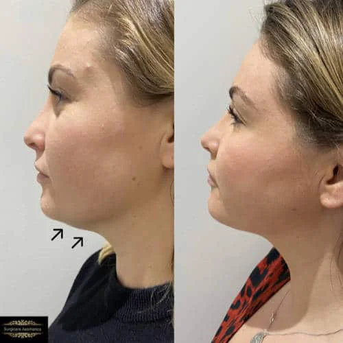 Before and After Aqualyx Fat Dissolving Injections