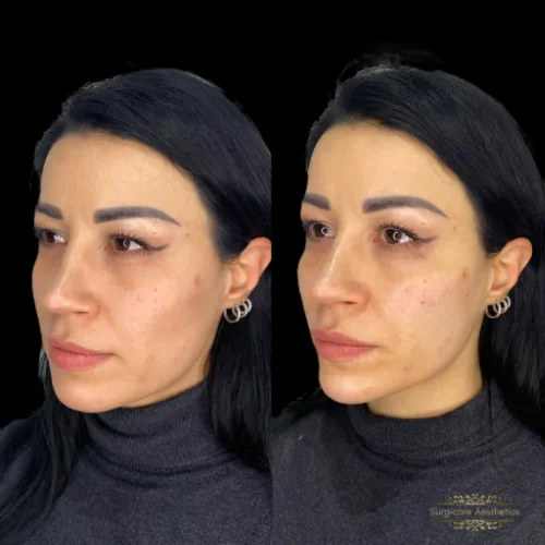 Before and After Cheek filler