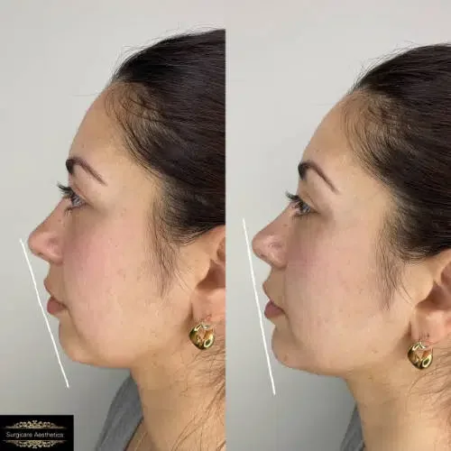 Before and After Chin and Jawline Enhancement