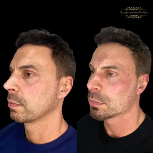 Before and After Chin and Jawline Enhancement