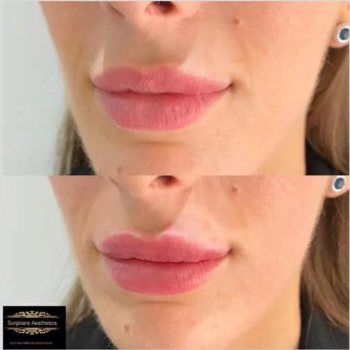 Before and After Lip Filler Correction