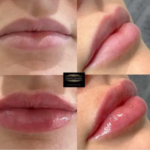 Before and After Lip Fillers with Juvederm