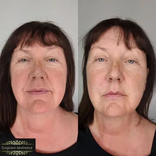 Before and After Nasolabial Line Filler