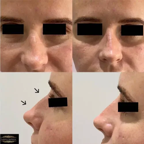 Before and After Non-Surgical Rhinoplasty 2