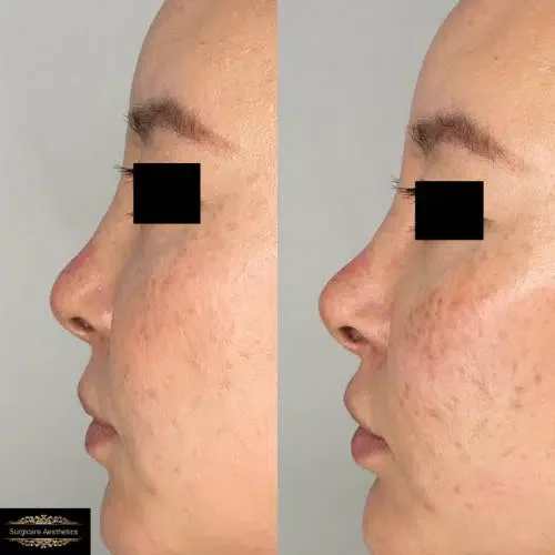 Before and After Non-surgical Rhinoplasty