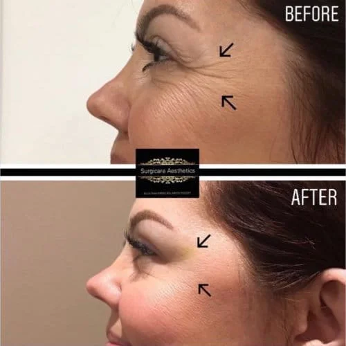 Before and After crows feet