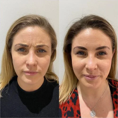 Before and After forehead lines