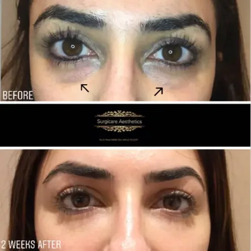 Before and After tear trough rejuvenation