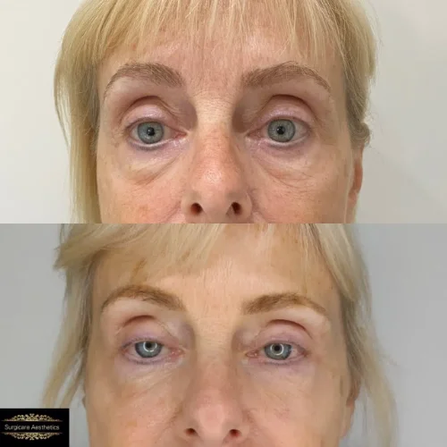 Before and Heart Tear Trough Rejuvenation