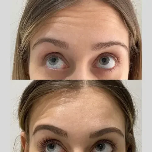 Before and after Anti-Wrinkle Treatment for Forehead Lines 2