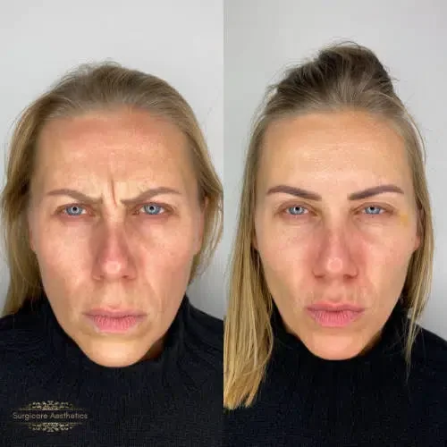 Before and after Anti-Wrinkle Treatment for Forehead Lines