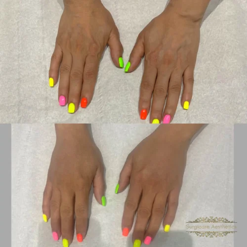Before and after Hand Rejuvenation