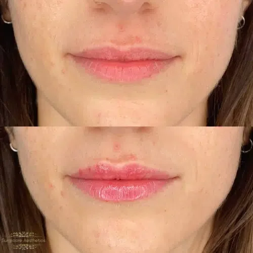 Before and after Lip Enhancement