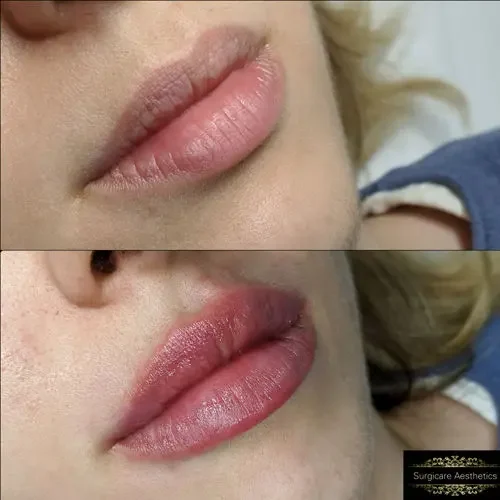 Before and after Lip Enhancement