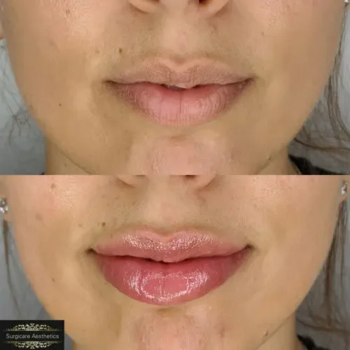 Before and after Lip Filler Tretament