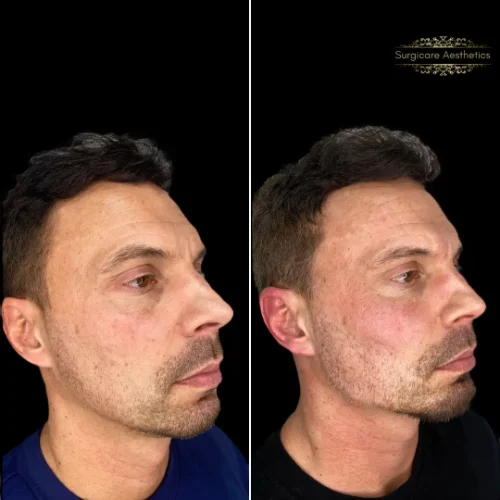 Before and after Masculinisation