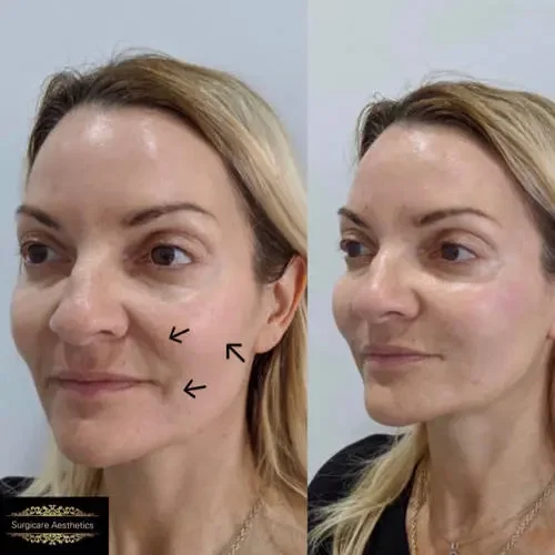 Before and after Nasolabial Line Filler