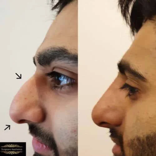 Before and after Non-Surgical Rhinoplasty 3