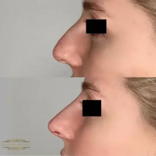 Before and after Non-surgical Rhinoplasty 2
