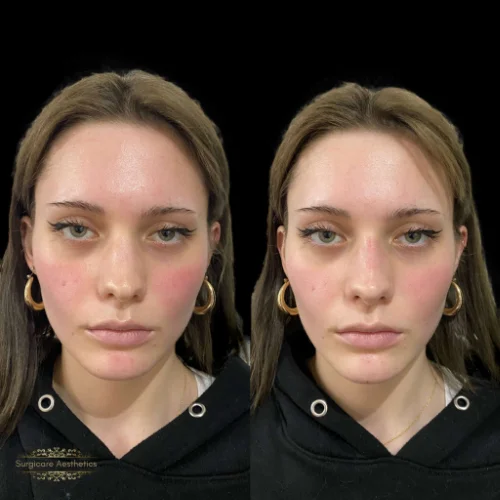 Before and after Non-surgical Rhinoplasty 9
