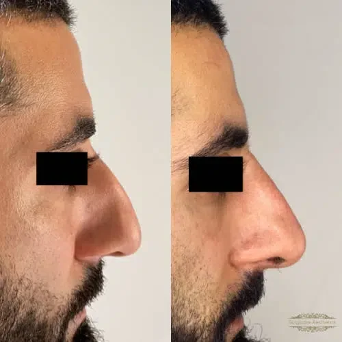 Before and after Non-surgical-rhinoplasty 4