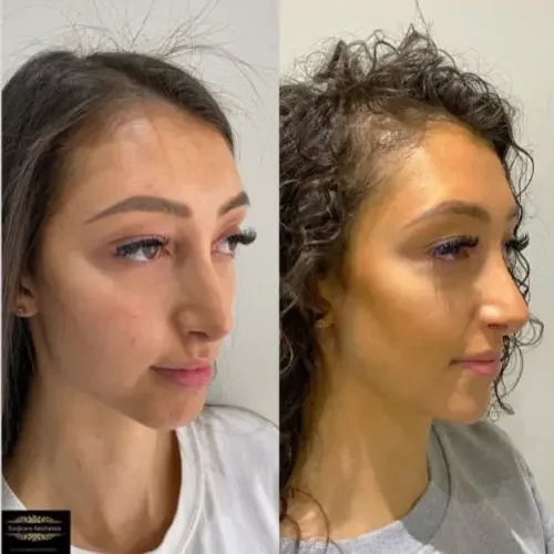 Before and after Peri-orbital Rejuvenation 1