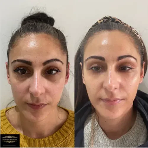 Before and after Peri-orbital Rejuvenation 2