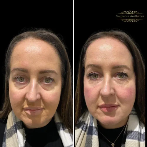 Before and after Peri-orbital Rejuvenation