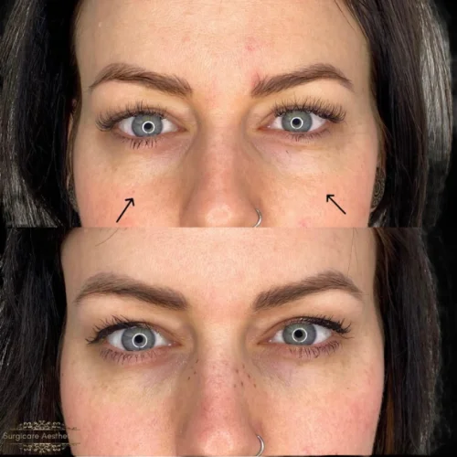 Before and after Peri-orbital Rejuvenation 5