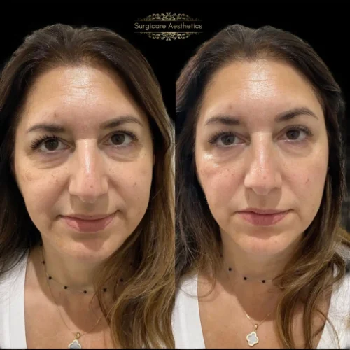 Before and after Peri-orbital Rejuvenation 6