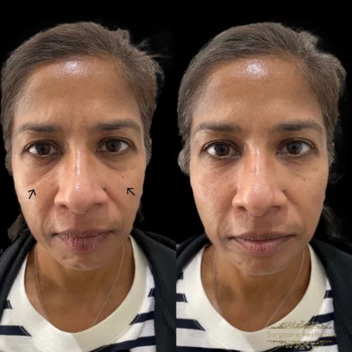 Before and after Peri-orbital Rejuvenation 8