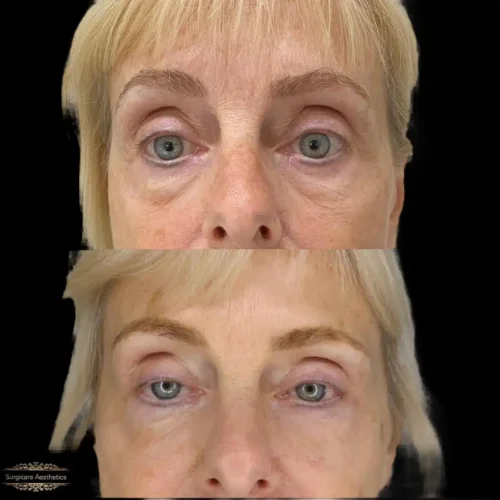 Before and after Peri-orbital Rejuvenation