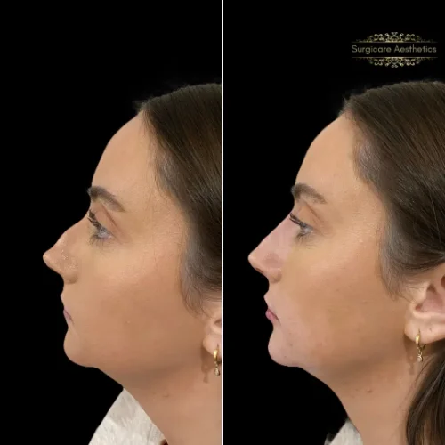 Before and after Profile Balance