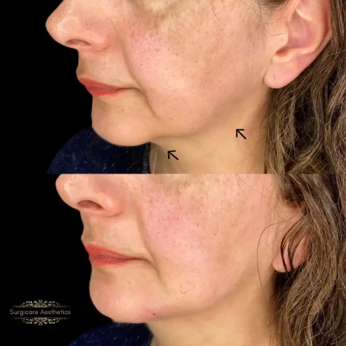 Before and after Structural Rejuvenation 3
