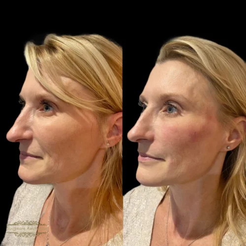 Before and after Structural Rejuvenation 5