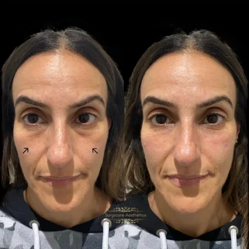 Before and after tear trough rejuvenation 3