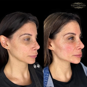 Chin & Jawline Filler before and after 3