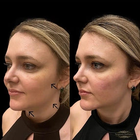 Chin & Jawline Filler before and after 5