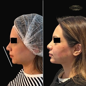 Chin & Jawline Filler before and after 7
